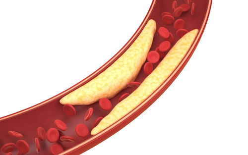 жировые бляшки в сосудах при атеросклерозе