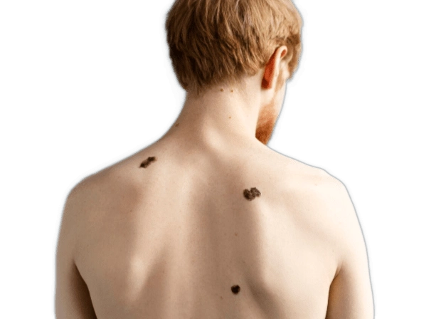 мужчина с раком кожи