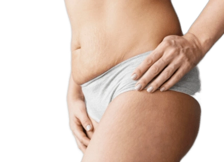 женщина с опухолью липосаркомы