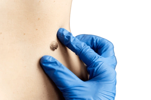 бородавки на теле