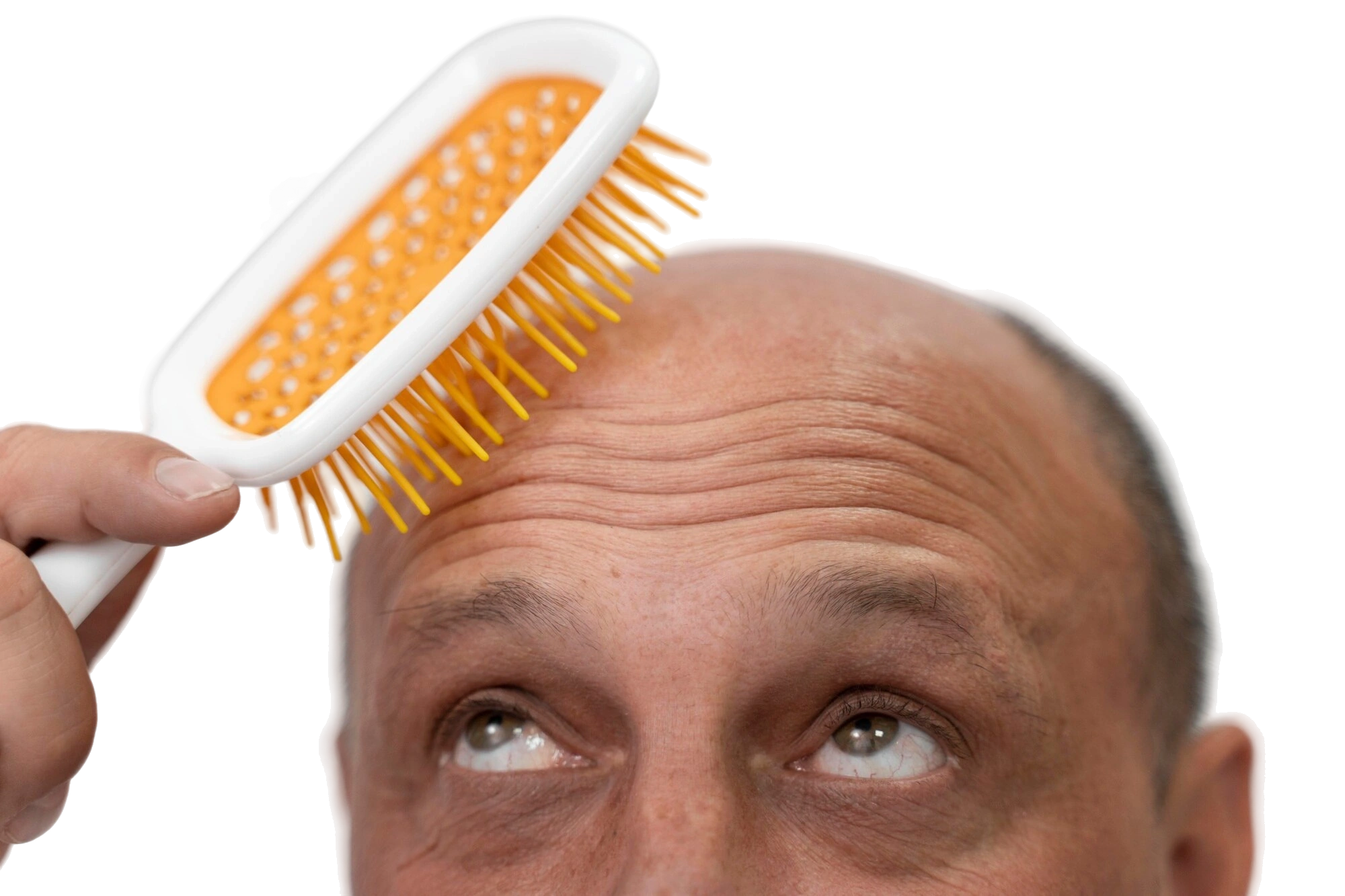 мужчина с алопецией