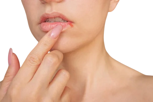 женщина с герпесом на губах