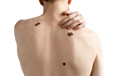 мужчина с меланомой на коже