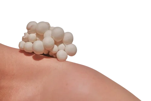 кандидоз на коже